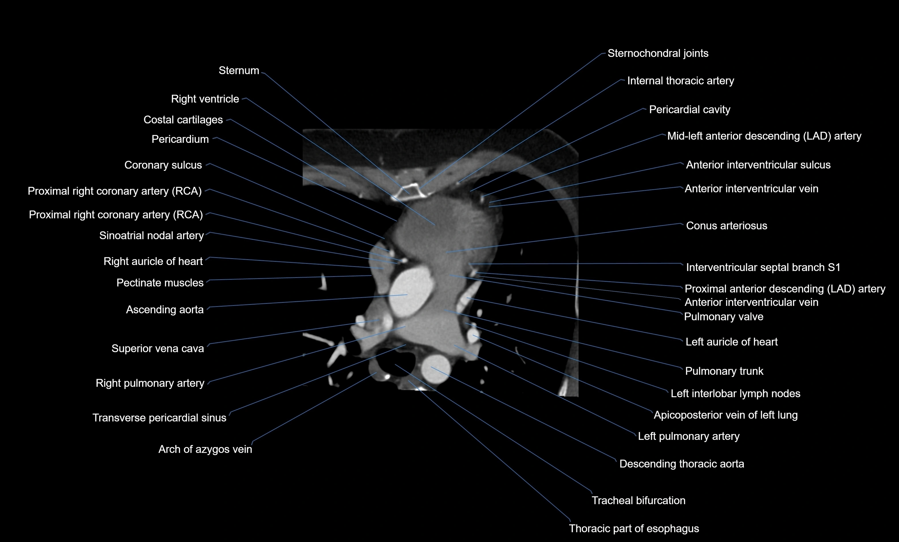 CT heart (coronary angiogram) four chamber view  cross sectional anatomy labelled radiology image -00017.webp